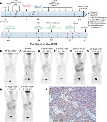 CD19 CAR-T Cells With Membrane-Bound IL-15 for B-Cell Acute Lymphoblastic Leukemia After Failure of CD19 and CD22 CAR-T Cells: Case Report